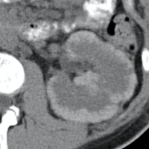 Kidney